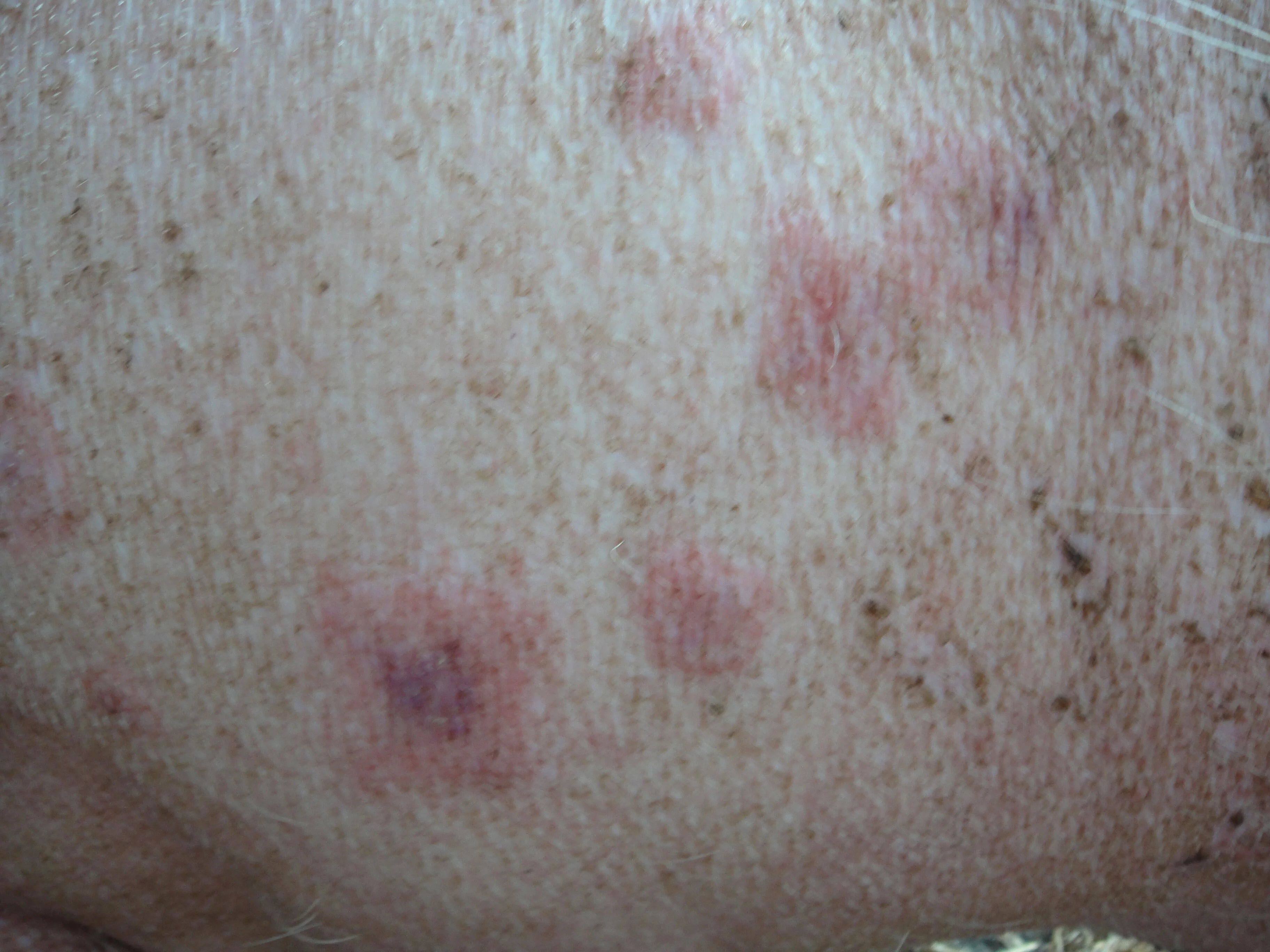 erysipelas lesions